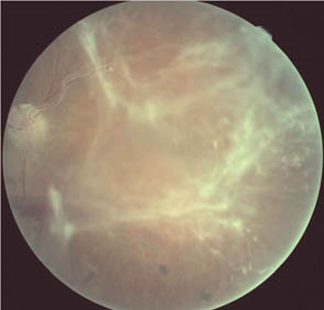 Old Retinal Detachment with Fibrosis